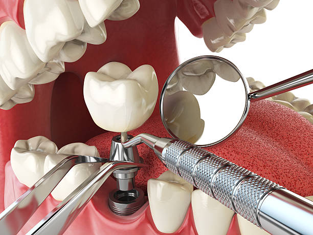 Best Emergency Tooth Extraction in Aventura, FL
